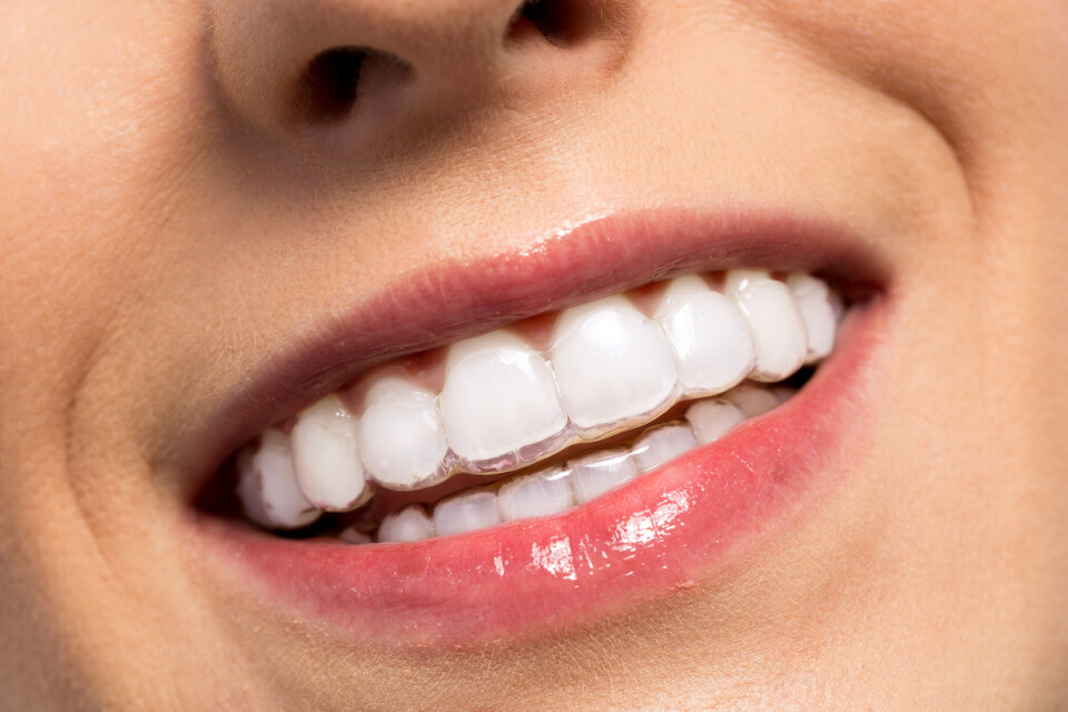 Expat Ortho - Invisalign clear aligners