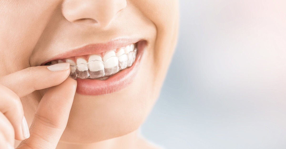 Expat Ortho - Invisalign clear aligners easy tu use